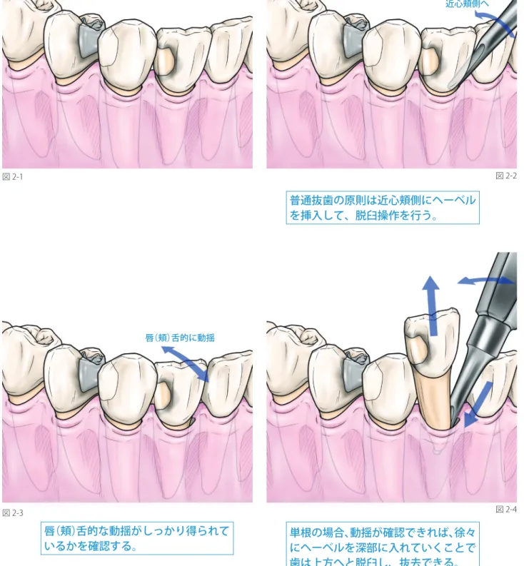 図 2-2 図 2-4図 2-1 図 2-3 唇（頬）舌的な動揺がしっかり得られて いるかを確認する。 普通抜歯の原則は近心頬側にヘーベルを挿入して、脱臼操作を行う。単根の場合、動揺が確認できれば、徐々 にヘーベルを深部に入れていくことで 歯は上方へと脱臼し、抜去できる。へーベルの効果的な用い方 近心頬側へ唇（頬）舌的に動揺