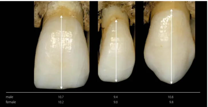 Fig. 6: Average anatomic crowns lengths of upper anterior teeth in mm according to Mühlreiter 1928 [1]