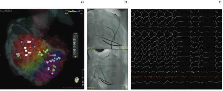 図 4　心室頻拍のアブレーション 　左室心室瘤表面の興奮伝播（a），カテーテル位置（b），通電中の心室頻拍停止（c）． （筆者作成） a b c d 図５　Brugada 症候群のアブレーション 　治療前の心電図（a），治療後の心電図（b），カテーテル位置（c），右室流出路 心外膜側の通電部位（d）． （筆者作成） ローチを併用する。不整脈原性右室心筋症，拡張型心 筋症，肥大型心筋症などで心外膜アプローチが必要な 場合がある。われわれの施設では，多くの心室頻拍の アブレーションを心外膜アプローチも含め積極的
