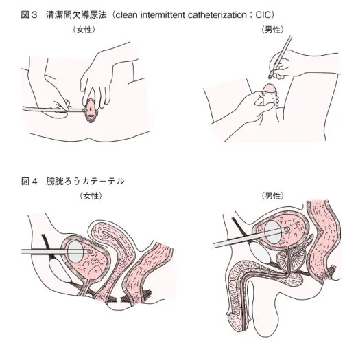 図 3　清潔間欠導尿法（clean intermittent catheterization；CIC）