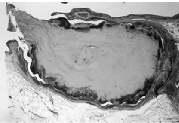 Fig. 3 （a）Clusters of degenerated eosinophils（CDE）and Charcot-Leyden crystals（←）in a mucous plug．