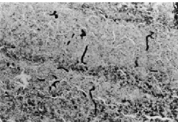 Fig. 6 CDE showing fir-tree structure （←）was found in the exudate of BrCG-Eo． （HE, original  magnifica-tion×4）