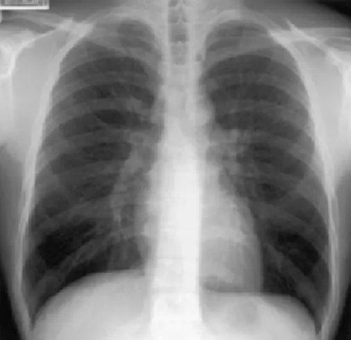 Fig. 3 Lung biopsy specimen of the lower lobe ob- ob-tained by thoracoscopy showing massive infiltration of eosinophils with a slight accumulation of plasma cells and lymphocytes on the bronchiolar walls and mucus plugs within the bronchiolar lumina