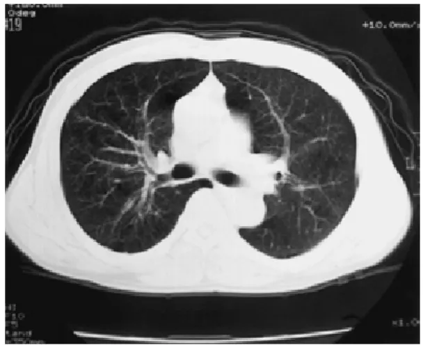 Fig. 2 Chest CT on April 14, 2001, demonstrating dif- dif-fuse low attenuation areas predominantly in the right lung.