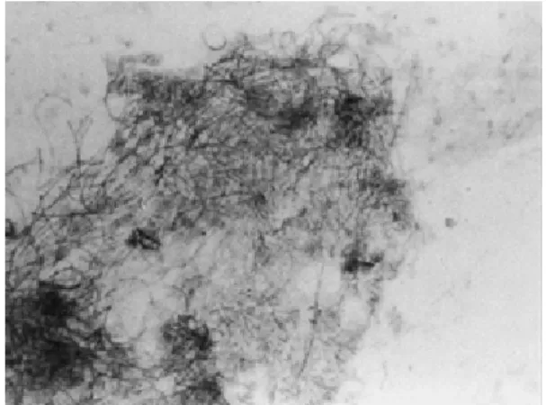 Fig. 4 Chest radiography shows multiple nodular and reticular shadows, some with cavitation.