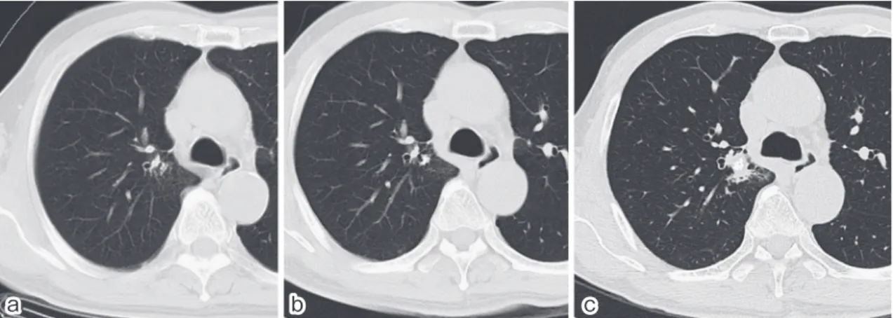 Fig. 2 a: Chest CT scans taken 60 months before admission showed localized bronchiectasis but no cal- Fig. 2 a: Chest CT scans taken 60 months before admission showed localized bronchiectasis but no cal-cification in the right upper lobe. b: Chest CT scans