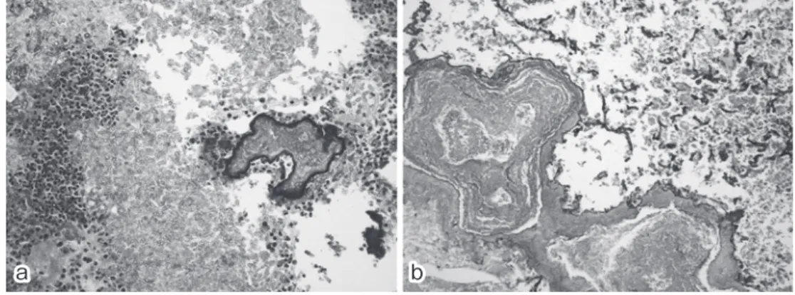 Fig. 4 After decalcification, we found that the stone was composed of a cluster of aspergillus hypnae (a:  HE stain, b: PAS stain).a b Table 2 The transition of allergic marker after the operation 1 month after the operation 12 months after the operation E