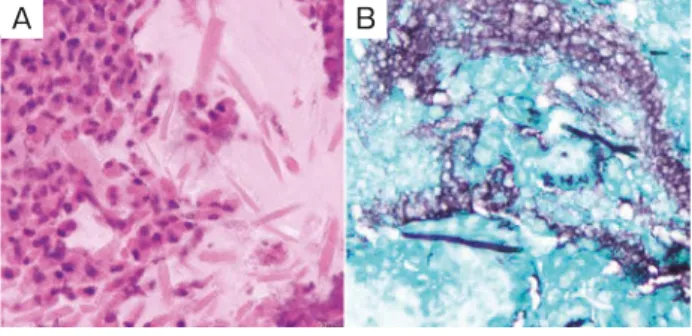 Fig. 3 Gram staining of sputum (×1,000). (A) Small  Gram-negative  bacilli  (arrows)  were  observed.  (B)   Gram-negative bacilli were phagocytosed by neutro-phil.