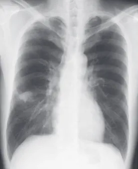 Fig. 1 Chest  radiograph  showing  a  nodular  lesion  with an irregular margin located in the right middle  field