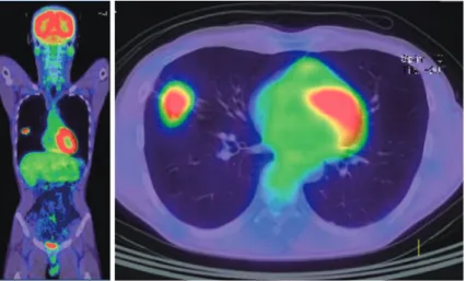 Fig. 3 A  PET-CT  scan  shows  an  abnormal  amount  of  FDG  accumulation  in  the  nodular  lesion  (SUV  max; 6.63 in the early phase, 8.87 in the late phase).