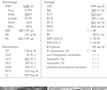 Tabl e 1 Labor at or y  dat a  on  admi s s i on  t o  our hos pi t al Ser ol ogyHematology mg/dl0.09CRP/μl9,200WBC I U/ml640IgE%17.6Neut μ g/ l44.2ECP%50.0Eosin U/ml352KL-6%27.4Lymph ng/ml56.5SP-A%4.4Mono ng/ml36.8SP-D%0.6Baso ＜ ×40ANA/μl406×104RBC I U/ml