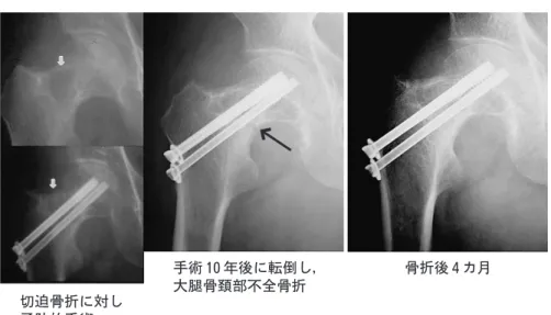 図 7 予防的手術が奏功した症例