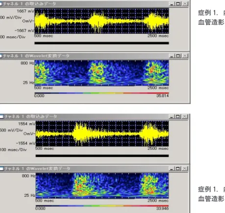 図 5 には，血管造影での PTA施行前のバスキュラ アクセス血管の狭窄性変化と， PTA 施行後の改善 （→）が示されている．数字は，心音センサの装着部 位を示している． ついで，バスキュラアクセスとして人工血管を使用 した例の血管音の解析結果を呈示する．図 6 では，上段にはPTA 3週間前，下段にはPTA 2 週間前の血管音の周波数と，そのwavelet変換による解析結果が示されている．3週間前から2週間前にかけて，高周波数成分の分布がより多くなり，次の血管音の始ま日本透析医会雑誌Vol.22 No.