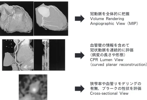 図 3 64列 VCT;angi ographi cvi ewによる石灰化表示