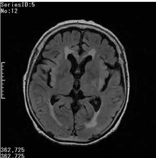 図 2 脳 MRI （9月 29日）T2強調画像 FLAIR画像拡散強調画像 表 3 髄液検査所見 細胞数 2 個/mm 3 総蛋白質 80. 4mg/dL グルコース 95mg/dL Cl 125
