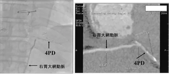 図 10 に示されるように胃大網動脈と右冠動脈後 下行枝の吻合部は CAGよりも MDCTで明瞭に描 出されている．このように MDCTはバイパス吻合 部の開存状態の診断に有用であり，時には CAG以 上に詳細な情報を提供することが示された． 今後の課題としては，内胸動脈グラフト手術の増加 に伴い，心臓部位だけでなく内胸動脈の起始部から冠 動脈吻合部までの広範囲の画像を描出することが求め られており，それには 16 列 MDCTでは限界があり， さらなる技術の進歩が望まれる． 7 透析患者の経皮的冠動脈拡張