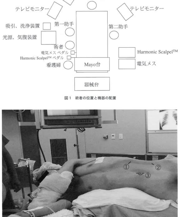 図 2 術中体位とポート留置部位