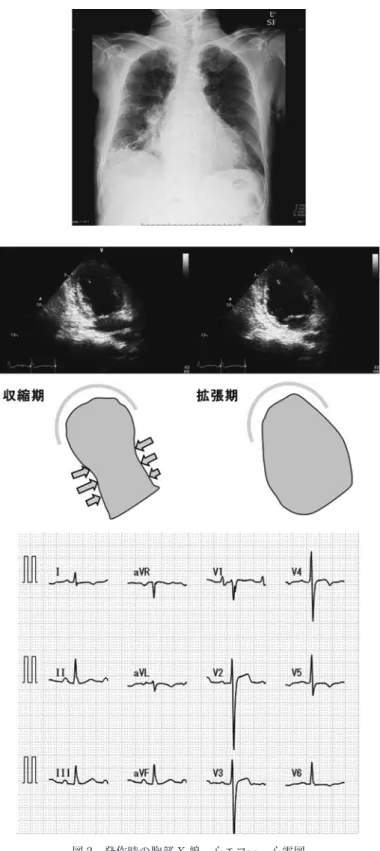 図 2 発作時の胸部 X 線，心エコー，心電図 胸部 X 線：CTR 56.7% であり，両側肺門のうっ血像を認める．心エ コー：心基部の壁運動は保たれているものの心基部以外は壁運動の 低下を認め，EF 27.3%．心電図：97bpm，V2-3 誘導で ST の上昇と V4-6 誘導で陰性 T 波を認める． を認めた．心電図（図 2）では，V2-3 誘導で ST の上昇 と V4-6 誘導で陰性 T 波を認め，心エコー（図 2）では， 心基部の壁運動は正常に保たれているものの心基部以 外の壁運動は高度に低下