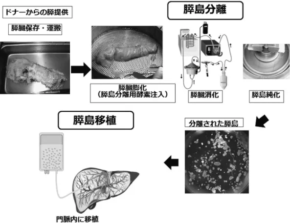 図 1 膵島分離と膵島移植 この方法は欧米での多施設共同試験へと発展し，膵島 移植を受けた 1 型糖尿病患者に，長期にわたる内因性 インスリン産生と血糖安定性を回復させることに成功 し，重症低血糖発作から解放されることが可能である とされた．しかし，長期的にインスリンを離脱するこ とは難しいことも示唆され，長期成績の改善が課題と なった １０） ． 本邦でも海外の動きをふまえ，日本膵・膵島移植研 究会の膵島移植班を中心として臨床膵島移植の実施が されてきた．2004 年に京都大学において本邦初の臨床 膵島移