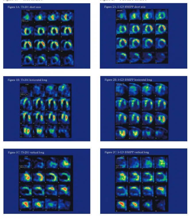 Figure 1:  201 TlCl SPECT Figure 2:  123 I-BMIPP SPECT