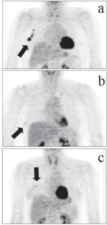 Table 1a Classification of accumulating pattern of FDG in breast region