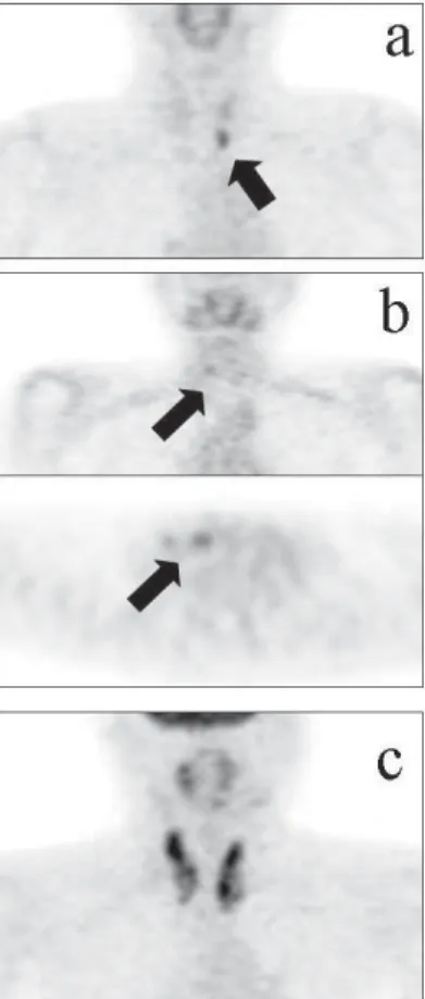Fig.  2   Representative uptake pattern of FDG in thyroid.
