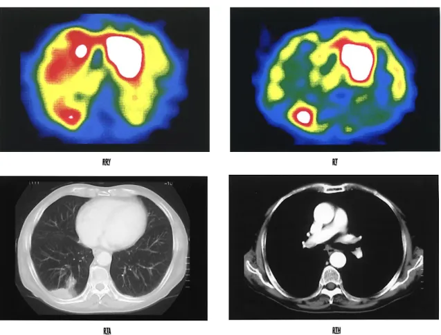Fig.  1 The chest CT and SPECT images of a 79-year-old man with lung moderately differentiated adenocarcinoma and pathological lymph nodes metastasis represent a typical case in N0 case of the chest CT
