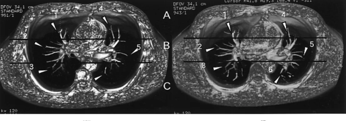 Fig.  1 CT-3D image (stopped in the inspiratory position (a) and in the expiratory position (b) during deep breathing) of which surface was rendered to present the pulmonary artery.