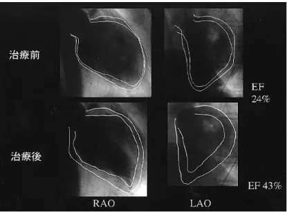 Fig.  3 The left ventriculography. The left ventriculography showed severely diffuse hypokinesis, and the ejection fraction (EF) was 24%