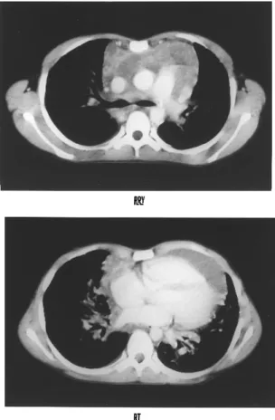 Fig.  2 A film of x-ray of the chest after the pericardial drainage shows that the increase of the CTR has returned to normal.
