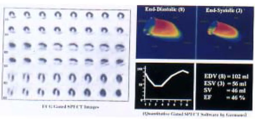 Fig.  5 Reliability of measurement of left ventricular end-diastolic and end-systolic volumes, and ejection fraction by the QGS software―Comparison with those measured by biplane left ventriculography (Simpson method).