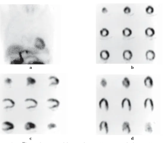 Fig.  4 99m Tc-tetrofosmin myocardial scintigraphy at rest. (a) Static image, (b) Short-axis, (c) Vertical-long axis, (d) Horizontal-long axis