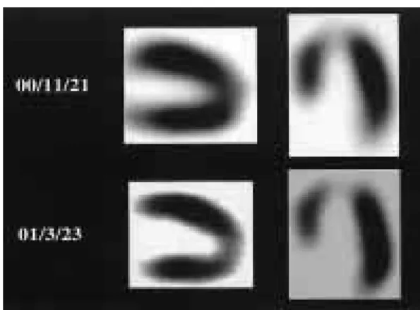 Fig.  9 99m Tc-tetrofosmin myocardial SPECT images revealed slightly decreased uptake in the apex, and showed no marked change during the clinical course.