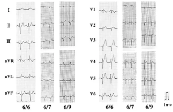 Fig.  1 Electrocardiogram on admission. Electrocar- Electrocar-diogram showed elevation of the ST-segment in leads I, aV L  and V 2 –V 5 