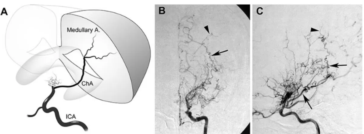 図 1:Choroidal anastomosis(A)とその代表的脳血管撮影所見(B,C) 交 絡 因 子 と し て 年 齢 ・ 高 血 圧 ・ PCA  involvement を想定し、これらで調整した多変 量解析を、Cox 比例ハザード法を用いて行った。  【結果】choroidal anastomosis は 37 例中 21 例 （ 56.8% ） で 陽 性 で あ り 、 choroidal  anastomosis 陽性・陰性群の間に、有意なベー スライン要因の差異は認められなかった。 
