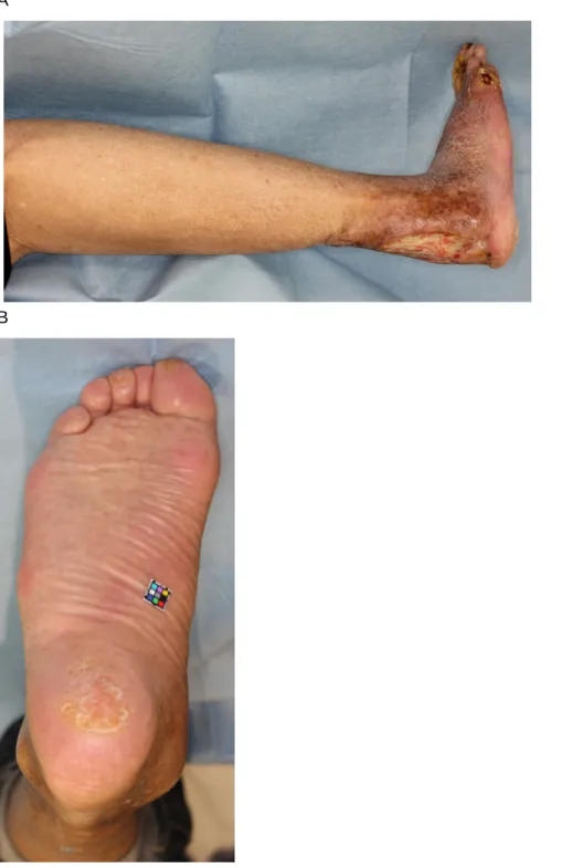 図 1  ウェルナー症候群の下肢典型像。(A)  皮膚軟部組織の硬化・萎縮は下腿遠位 1/3 以遠 で著しい。（B）潰瘍のない比較的良好な状態の足であるが、踵部には胼胝がみられる。 