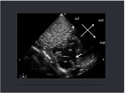 Fig. 1  Neonatal echocardiography