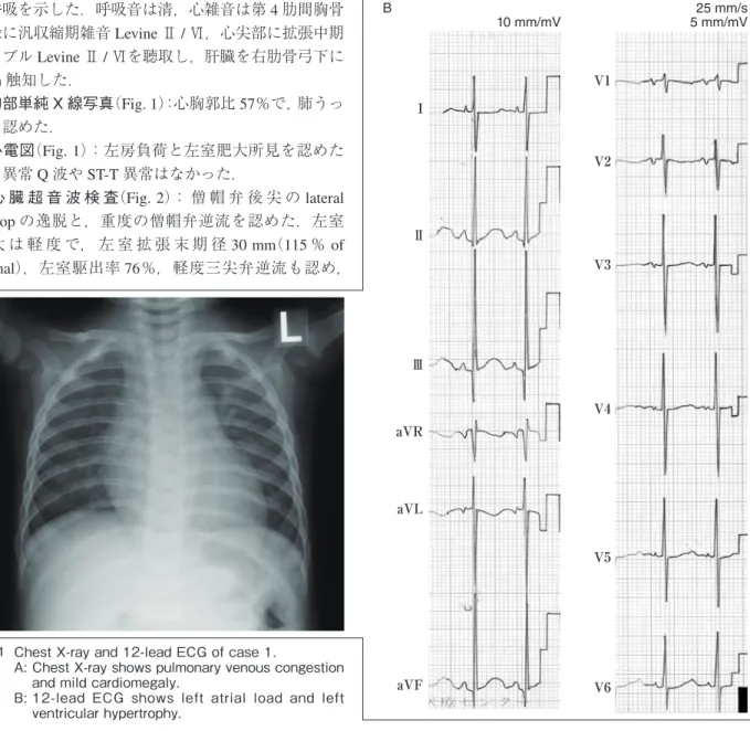 Fig. 1  Chest X-ray and 12-lead ECG of case 1.