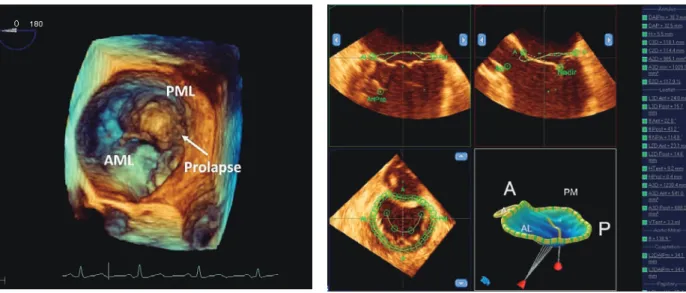 Fig. 1  Three-dimensional  transesophageal  image  of  the  mitral  valve  prolapse  of  posterior  middle  scallop