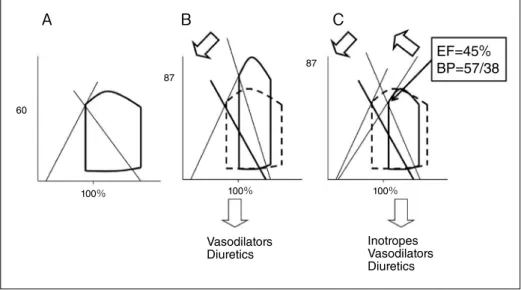 Fig. 7  The schema of PV loop in PDA A : PV loop of the symptomatic PDA