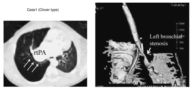 Fig. 3   CT images of bilateral main bronchial stenosis (case1)