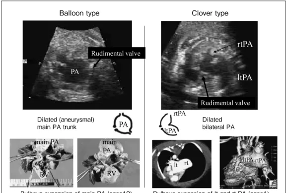Fig. 5  Excurved supra vena cava compressed by pulsative dilated  pulmonary artery (arrow)