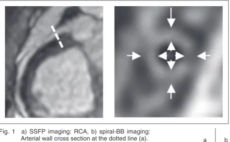 Fig.  1 a)  SSFP  imaging:  RCA,  b)  spiral-BB  imaging: 