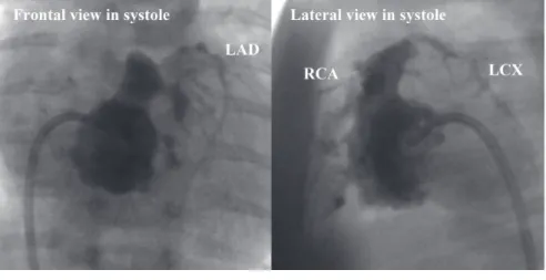 Fig. 1  Right ventricle angiography (15 days of age).