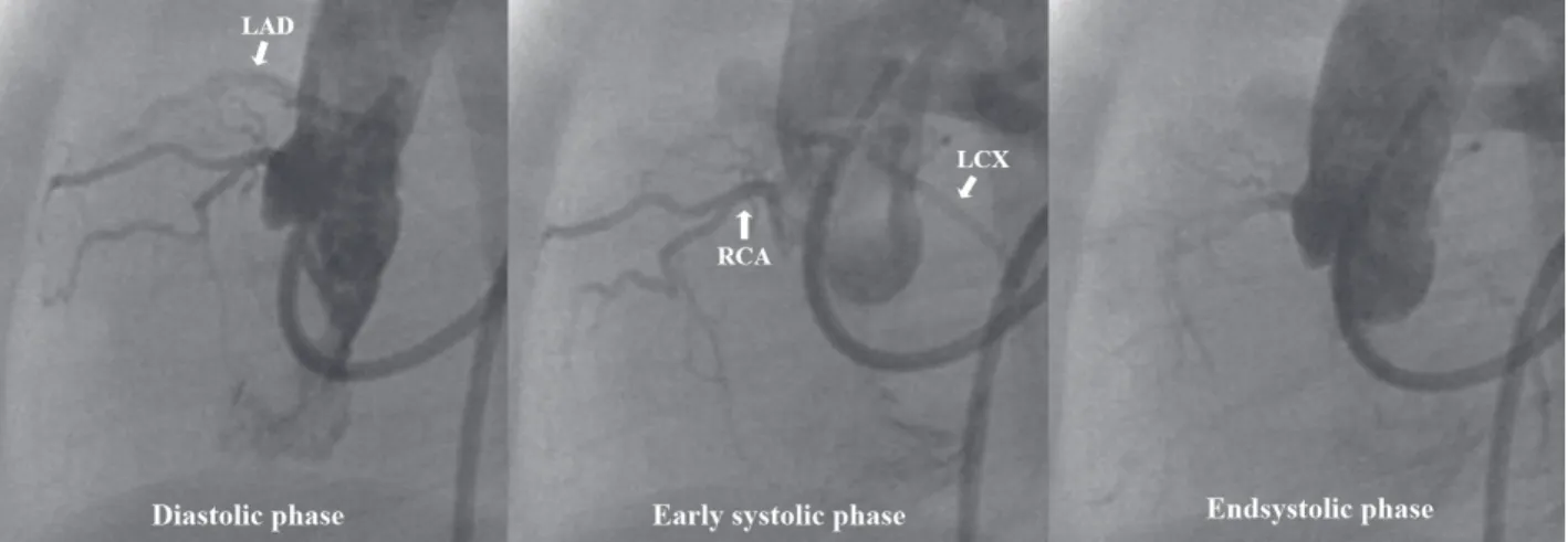 Fig. 2  Aortic root angiogram (15 days of age).