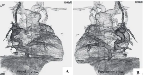 Fig. 7  Multi-detector row computed tomography imaging of total anomalous pulmonary venous  connection (TAPVC)