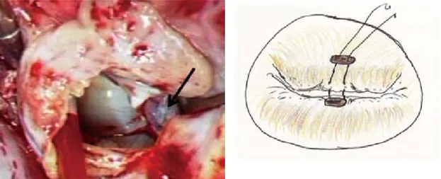 Fig. 2  Perioperative view and schematic representation of Alﬁeri’s edge-to-edge repair with  central  leaﬂet  edge  approximation  resulting  in  a  double-oriﬁce  valve