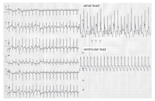 Fig. 2  ECG of case 2 (Idiopathic VT/VF). 