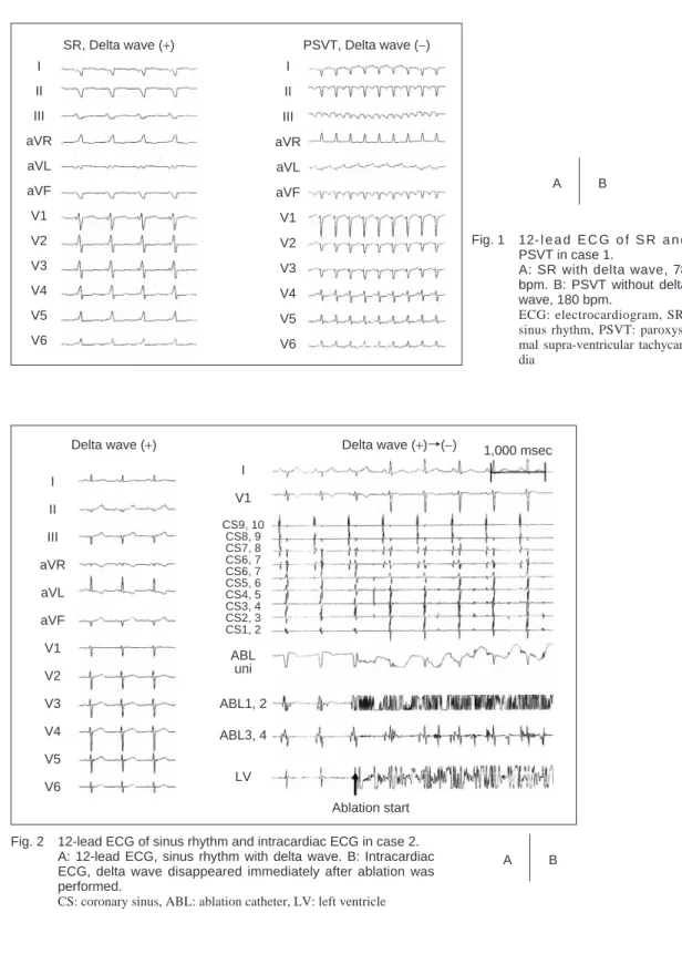 Fig. 1  12- l e a d  E C G  o f  S R  a n d  PSVT in case 1.