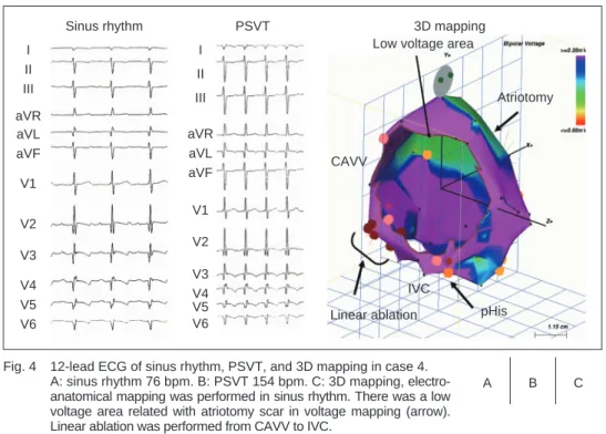 Fig. 4  12-lead ECG of sinus rhythm, PSVT, and 3D mapping in case 4.